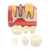 Manequim Dente Boca Modelo Odontológico