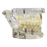 Manequim Dentista Modelo Odontológico Implante Acrílico