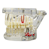Manequim Modelo Implante Odontológico Dentista Acrílico