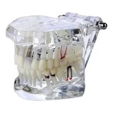 Manequim Modelo Odontológico Dentário Implante Acrílico