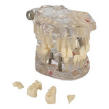 Manequim Modelo Odontológico Dentário Implante Prótese