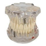 Manequim Modelo Odontológico Dentistas Implantes Próteses