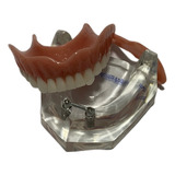 Manequim Modelo Odontológico Overdenture Barra Clip Inferior
