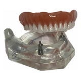 Manequim Modelo Odontológico Overdenture O-ring P/