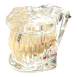 Manequim Modelo Odontológico Prótese Implante