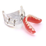 Manequim Modelo Odontológico Prótese Sobre Implante