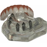 Manequim Modelo Odontológico Protocolo Superior P/ Dentistas