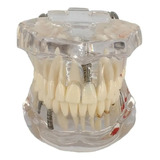 Manequim Odontológico Demonstrativo Canal Implantes Próteses