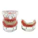 Overdenture