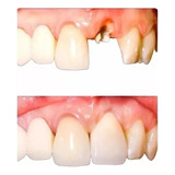 Snap On Smile Dentes Em Resina: Encaixe Onde Falta 1 Dente