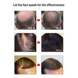 Tonicos Para Crescer Cabelo Natural Calvice Feminina Hair