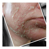 Ácido Retinóico 20ml 40 Pelling De Tca