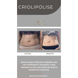 Criolipolise E Tratamento Para