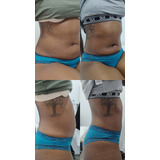 Hidrolipo Redução De Medidas