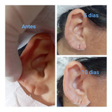 Lobuloplastia Não Cirúrgica