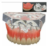 Implantes