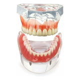 Overdenture