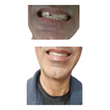Massa Restauração Dente  Tampa Buraco Dental  Provisórios