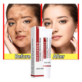 Melhor Creme Pra Melasma Coreano Remove Sarda Controla Acne