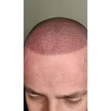 Micropigmentacao Capilar Procedimento Para