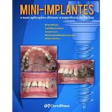 Mini implantes E Suas Aplicações Clinicas