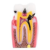 Modelo De Anatomia Dentária, Modelos De Estudo De Comparação De Cáries Dentista Anatomia Odontológica Educação Modelo De Dentes Modelo De Desenvolvimento De Cáries Dentárias