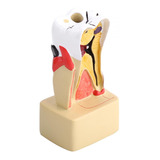 Modelo De Dente Para Doença Patológica Abrangente Dentária C