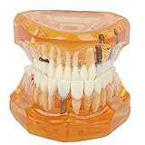 Modelo De Dentes De Estudo Removíveis Dentários Implante Demonstrativo Com Prótese Fixa Para Reconstrução Correta E Prevenção De Dentes Adjacentes Ideal Para Consultórios