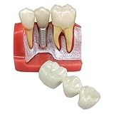 Modelo De Implante Dentário Typodont 4 Vezes Modelo De Dentes Análise Removível Coroa Ponte Demonstração Dentes Modelo Para Ensino De Classe E Estudo M2017