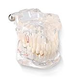 Modelo Dentário Modelo De Prótese Dentária Fixa Modelo De Ensino De Doenças Dentárias Auxiliares De Ensino Para Escolas De Odontologia