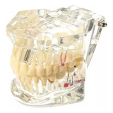 Prótese De Implante Dentário Manikin Dental Model