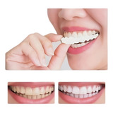 Protese Lente Faceta Removivel par Provisória