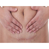 Remover Cicatrizes Gravidez Creme Tratamento Estrias